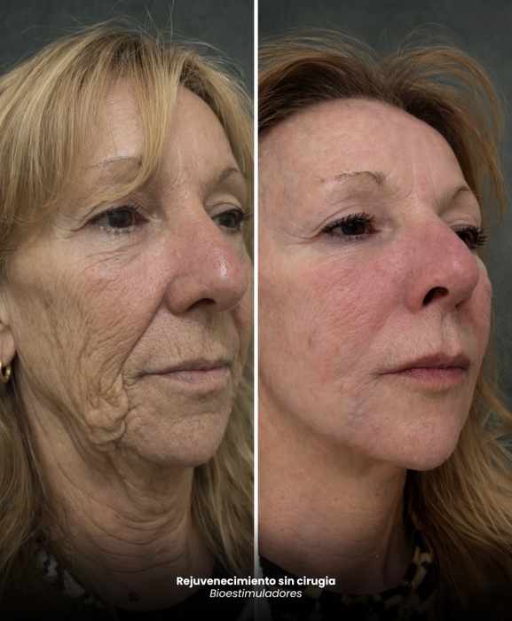 Resultado facial con Skin Glow