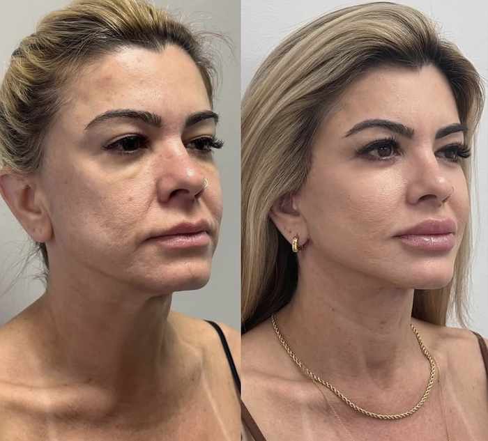 Resultado de tratamiento de manchas con Skin Glow