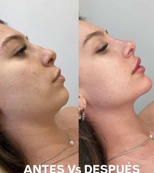 Resultado de perfil facial con Skin Glow